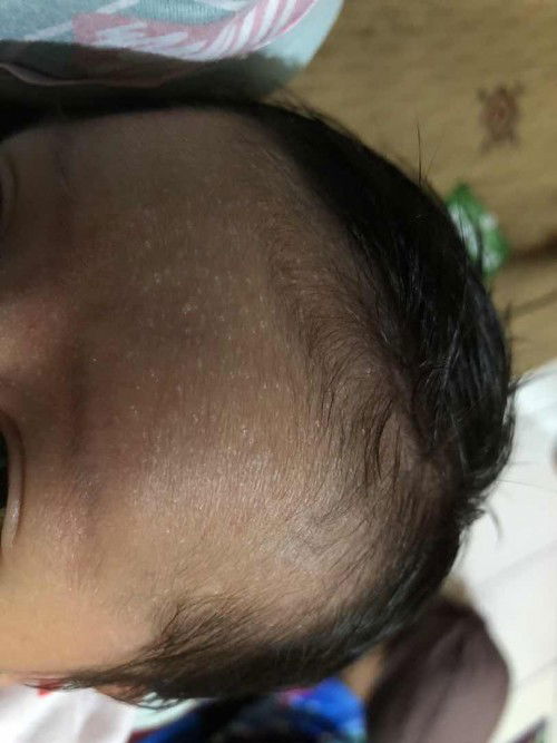 Beruntusan di jidat bayi