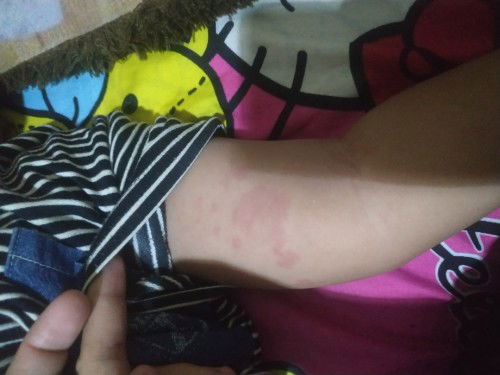 Ruam seluruh badan pada anak usia 3,5 tahun