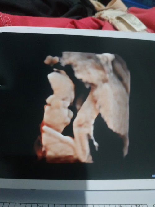 Posisi janin saat usg