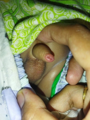 ujung kemaluan bayi merah dan bengkak seperti iritasi, itu bisa di obati dgn apa bun?