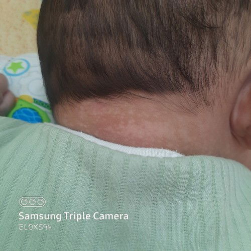 bercak putih pd kulit bayi