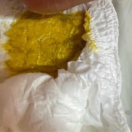 ลูกถ่ายเป็นมูก นมแม่ล้วน