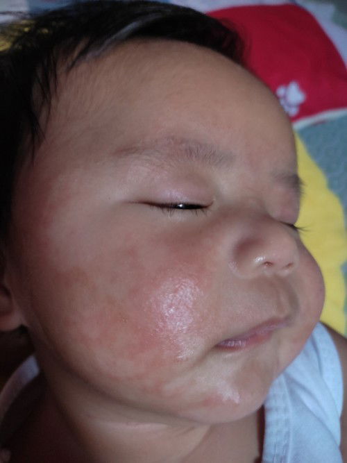 Mahigit na isang buwan na facial rash ni baby, normal lng po ba? Ano po kaya ang pwedeng gawin dito?