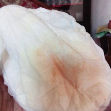 Pipis berwarna pekat?