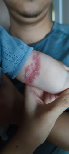 Is this ezcema or?
