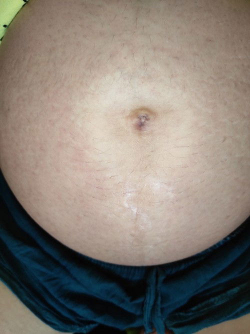 Hallo bunda² mau tanya kenapa ya warna perut sekitar pusar warnanya agak pucat dibanding sekitarnya?