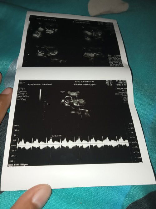 Assalamu'alaikum bund ada ndak disini bunda yang mengalami pas usg cwok tapi pas lahir prempuan