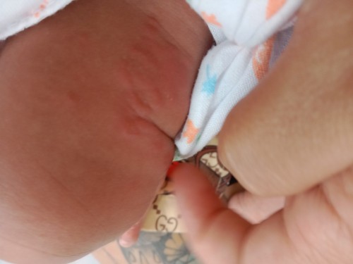 ไปหาหมอแล้วทีแรกขึ้นแค่ตุ่มสองตุ่ม หมอบอกแพ้ยุง พอวันสองวันเริ่มลาม