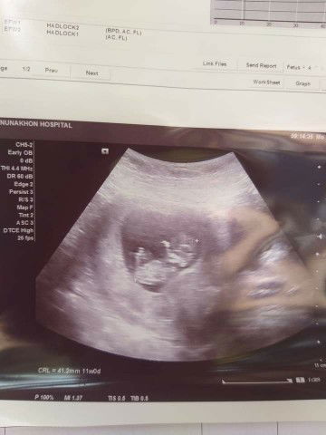 แม่ๆคนไหนท้องเเรกไม่ชอบทานหวานเเต่ได้ลูกชายพอท้องสอง
ชอบทานเเต่ของหวานๆอายุ
ครรห์14สัปดาห์เเล้วจ้า