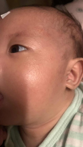 Butlig sa face ni baby