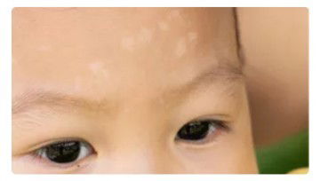 Cara Menghilangkan Panu pada balita 1 tahun