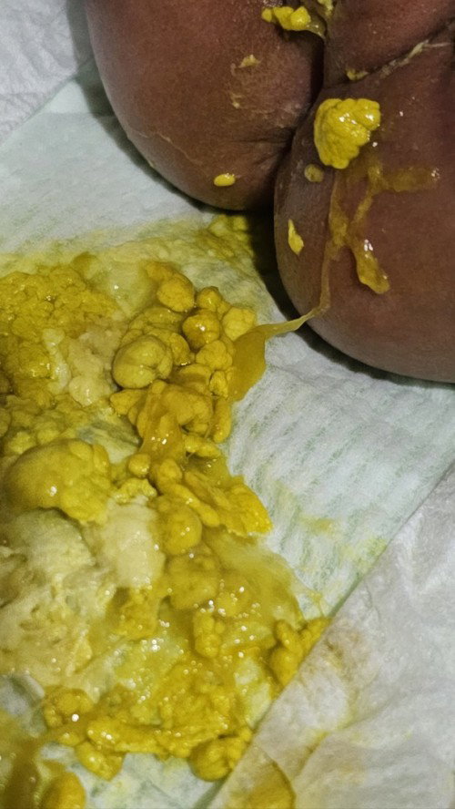 Is this poop normal for formula fed baby