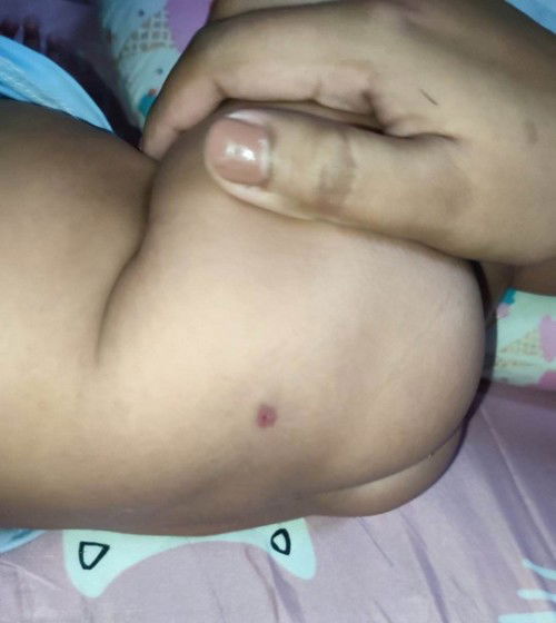 Hi mga mommies sugat sa pwet, ano po kaya tong tumubo kay baby sa pwet napansin po nmn na may ganyan