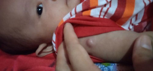 Setelah imunisasi BCG