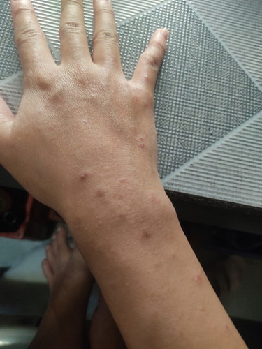 Pwede bang gumamit ng BL Cream ang Buntis 17 weeks, para sa pagpahid lang sa kamay.