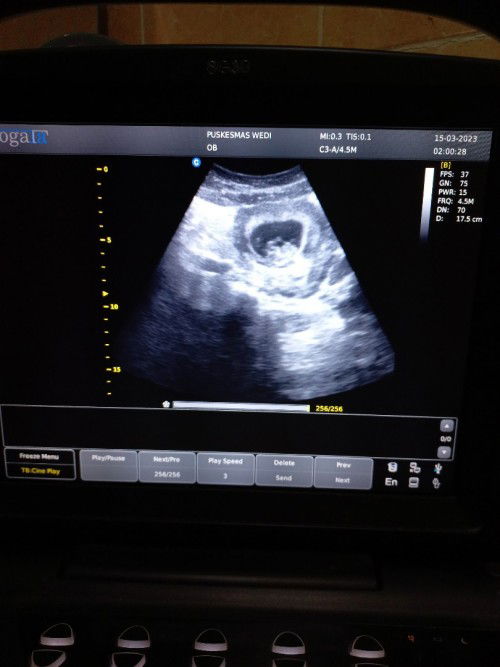 Bentuk janin 10 minggu