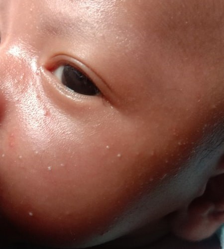 Milia pada bayi