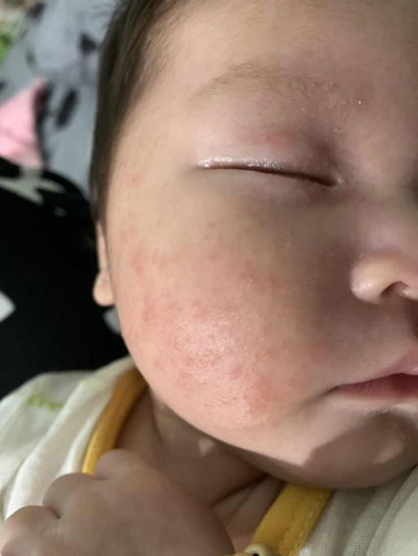 Mặt bé nhà e bị mẩn đỏ như vậy là bị sao ạ