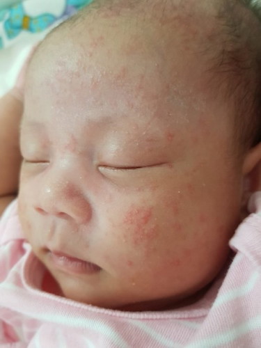 ผื่นขึ้นหน้า ปกติไหมคะ