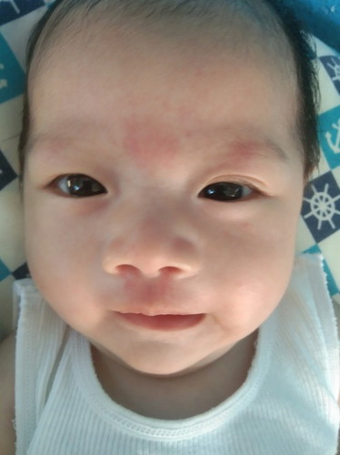 Namumula sa gitna Ng kilay ni baby