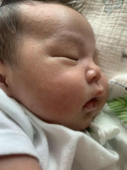 น้อง1 เดือนแล้วค่ะ หน้าเป็นผด เป็นๆหายๆ ยิ่งถ้าอากาศร้อน ก็จะแดงขึ้นมา ตอนนี้ลองใช้เฟแอนด์เม ก็ยังเป็นๆหายๆค่ะ