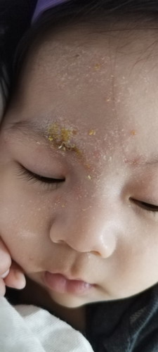 Baby's sensitive skin