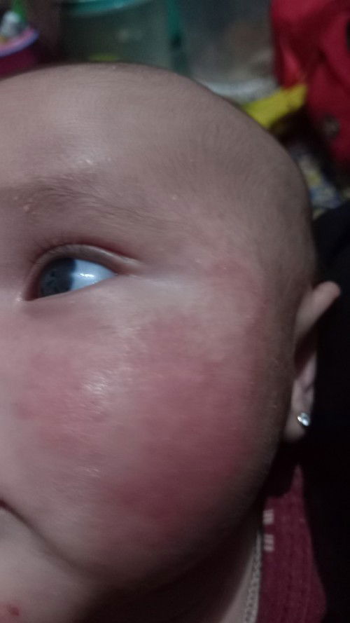 Ruam dan bruntusan di muka