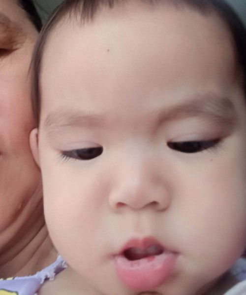 โรคเริมในปาก