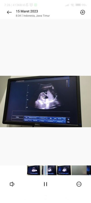 hasil usg janin