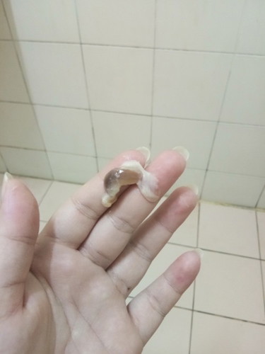 ตรวจปากมดลูก เปิด 1 เซน