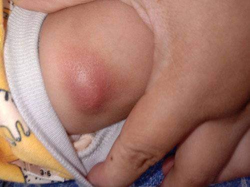 Imunisasi dpt 1 polio pvc