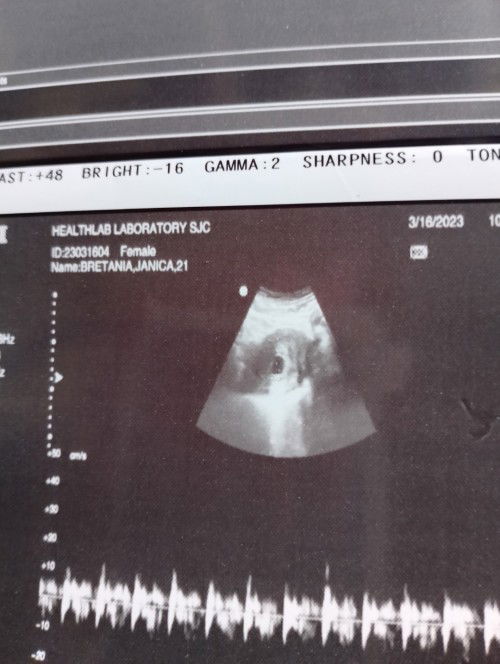 Normal po Ba na ganito palang sya kalaki