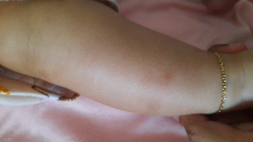 Cara menghilangkan bekas hitam gigitan nyamuk dan semut