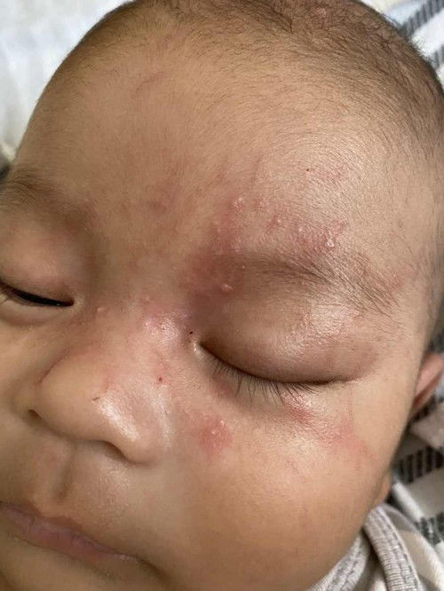 euam ruam di area mata