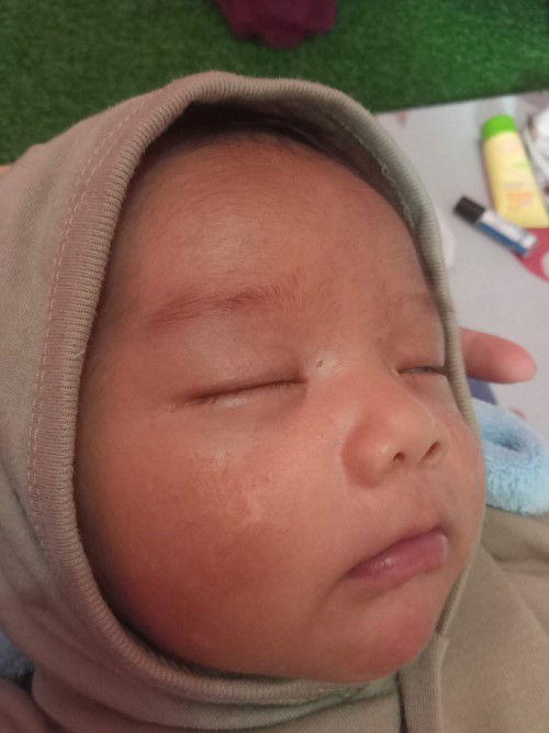 Bercak putih pada wajah anak