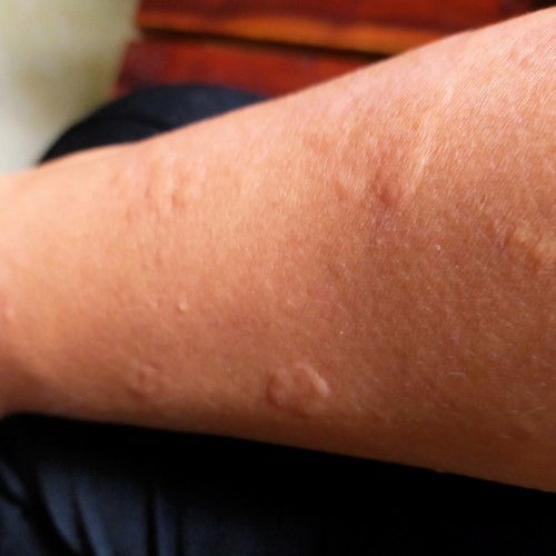 ตั้งภรรค์ได้11สป2วันมีผื่นคล้ายลม พิษขึ้น คันทรมานมากๆมีคุณแม่ท่านไหนเคยเป้นบ้างค่ะ  ขอคำแนะนำหน่อยค