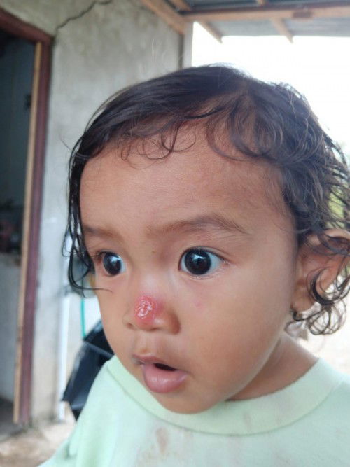 Merah ada airnya pada kulit bayi