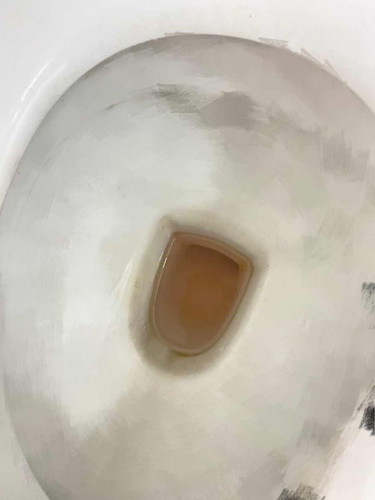 09:00เรามีปวดท้องแบบหน่วงๆเหมือนจะเป็น ปจด.แล้วก็หายไปประมาณ23:13 15สัปดาห์ ฉี่เสร็จเช็ดทำความสะอาดมีเลือดติดทิชชู