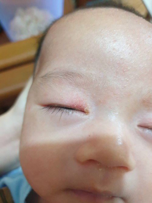 Iritasi mata bayi