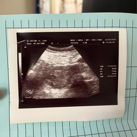 Usg belum kelihatan janinnya