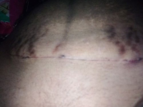 Penyembuhan operasi caesar eracs