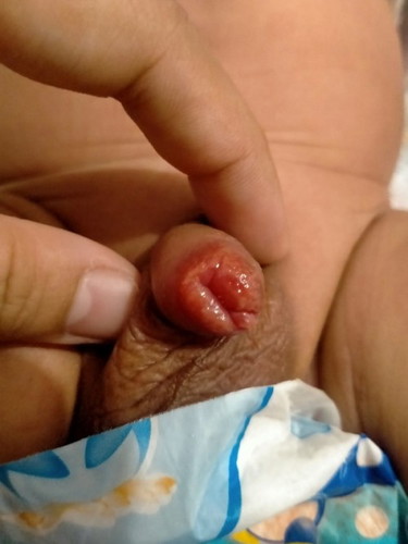 Diaper Rash ?