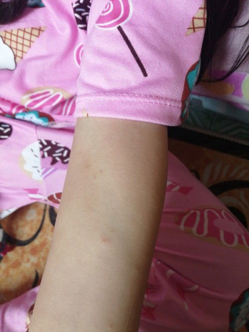 my rashes po sa katawan baby ko sa braso kamay binti paa, wala sya lagnat,.. posible po kaya na HFMD