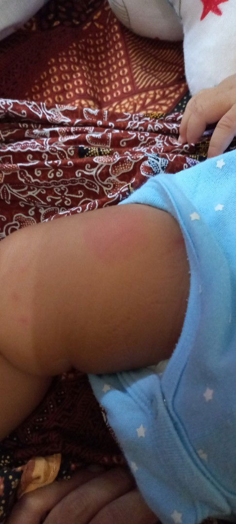 Paha merah setelah imunisasi