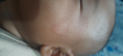 Muka bayi bruntusan
