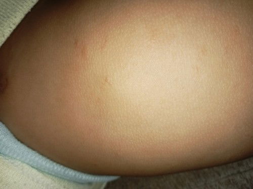 Bun mau tanya anak saya keluar kayak gitu kenapa yah bun solusinya biar hilang bintik"nya dikasih ap