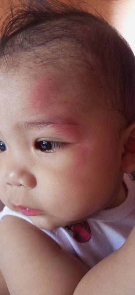 5-month-old baby fell from bed