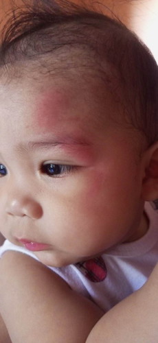 5-month-old baby fell from bed