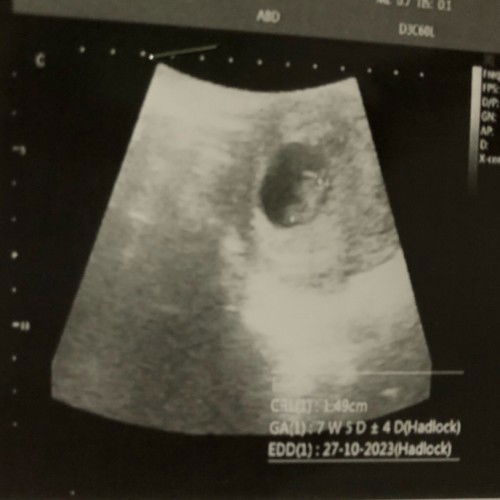 7W5D detak jantung belum terdengar