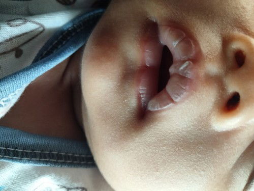 Bibir pecah pecah dari lahir